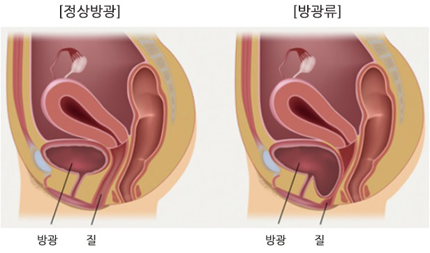 정상방광 방광류