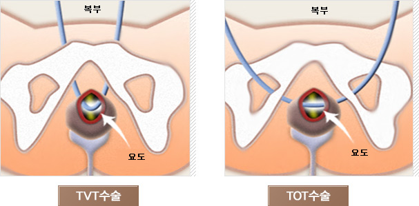 TVT복부수술 사진과 TOT복부수술 사진