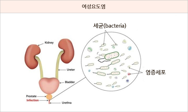 방광염배뇨장애클리닉소개 여성진료에 대한 모든 고민!! 이제 타워여성클리닉에서 모두 해결하세요