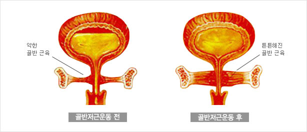 골반저근운동전후 이미지