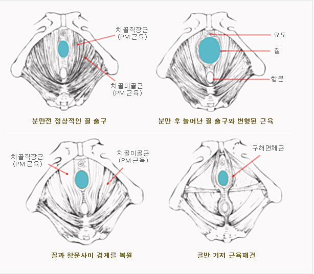 이쁜이 수술과정